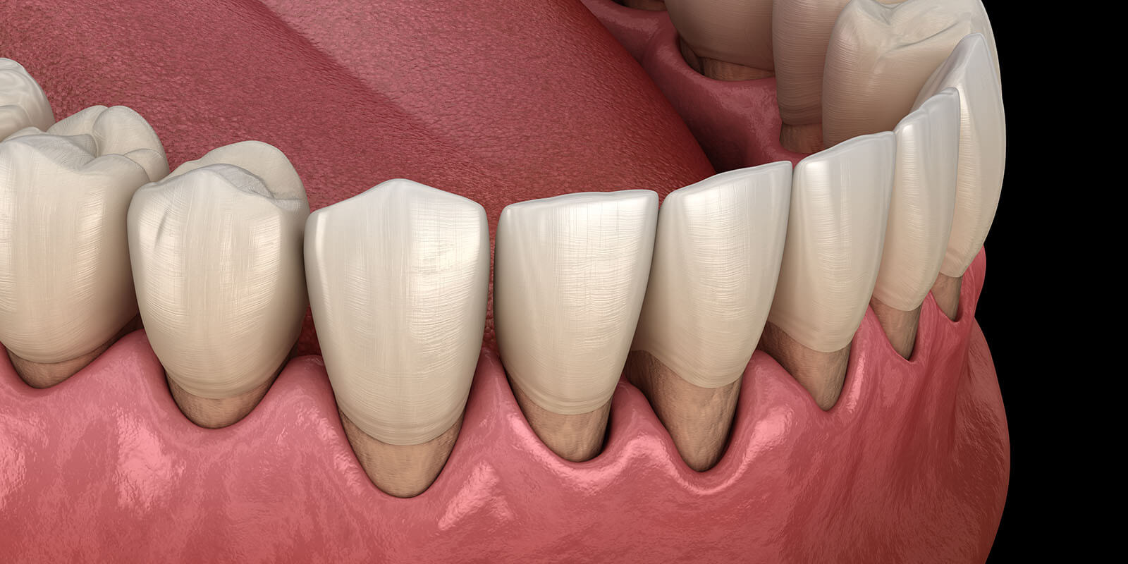 歯周病の症状と原因